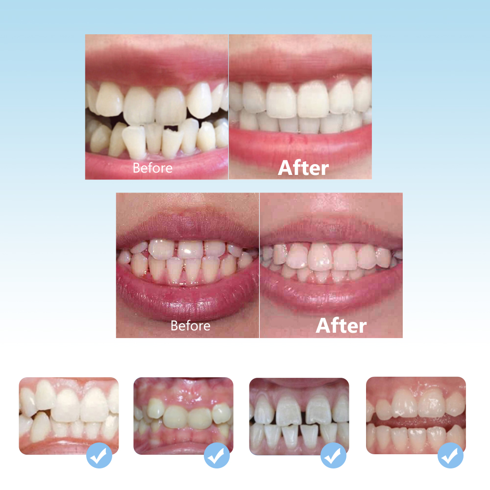 Dental Orthodontic Braces Set  - огляд і ціна Teeth Whitening Mouth Guard