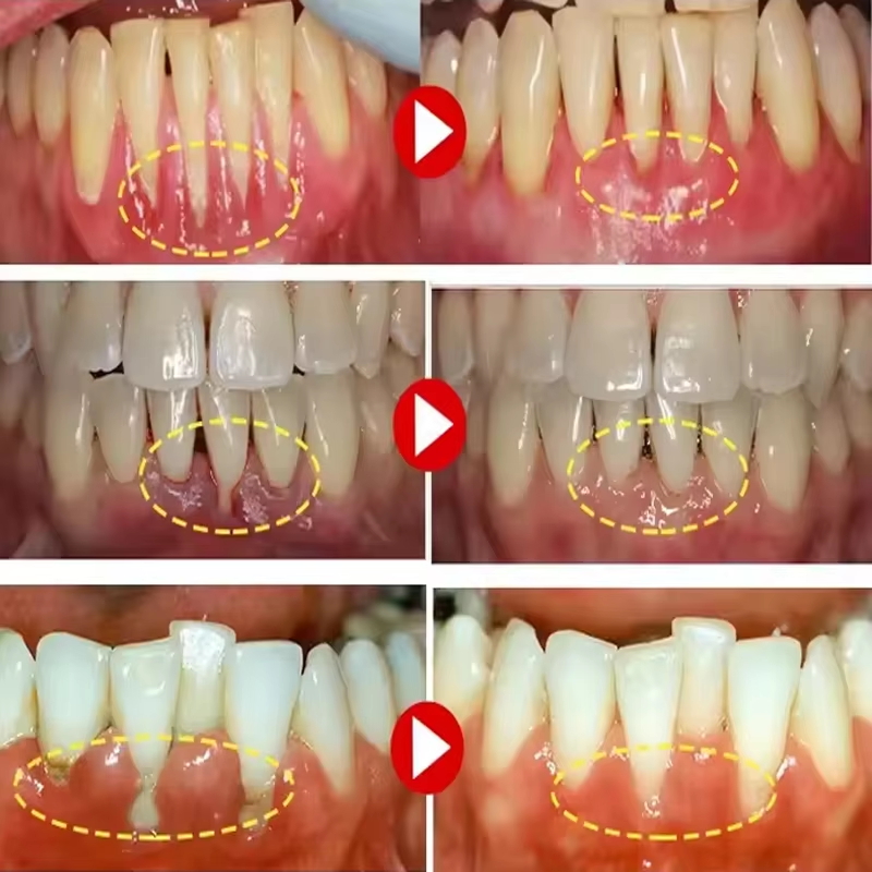 Teeth Whitening Gel Gum Repair - огляд і ціна Teeth Whitening Gels