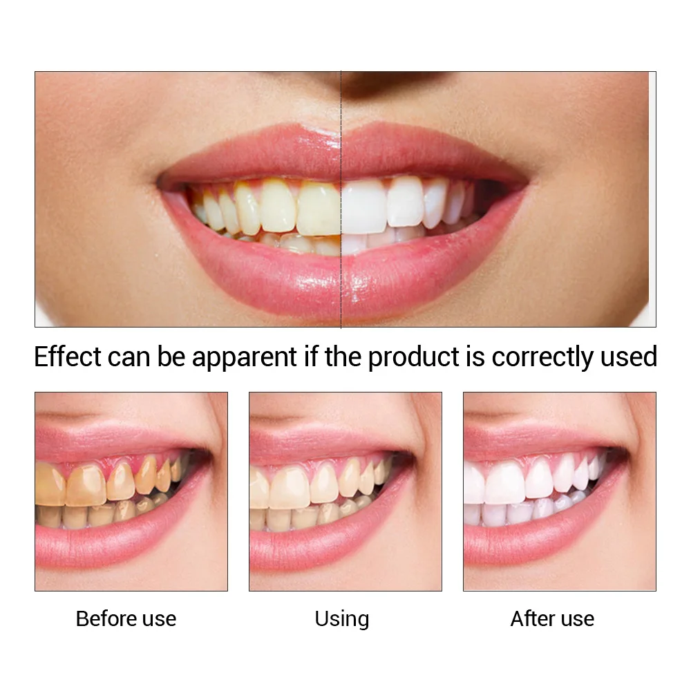 FTEENPLY Teeth Whitening Essen - огляд і ціна Teeth Whitening China
