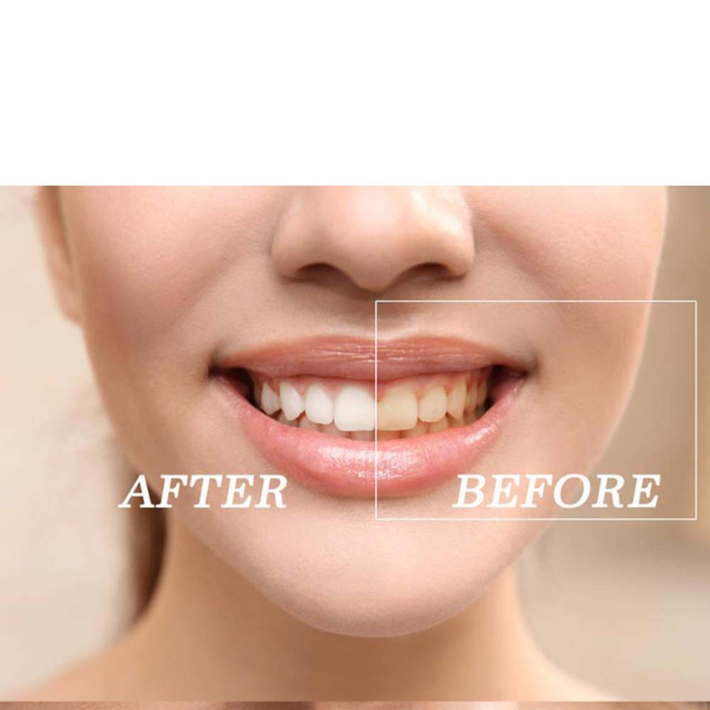 Top Quality Peroxide Teeth Whi - огляд і ціна Teeth Whitening Kit With Light