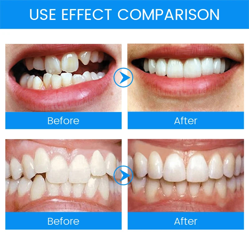 3 Stages Dental Orthodontic Br - огляд і ціна Teeth Whitening Mouth Guard