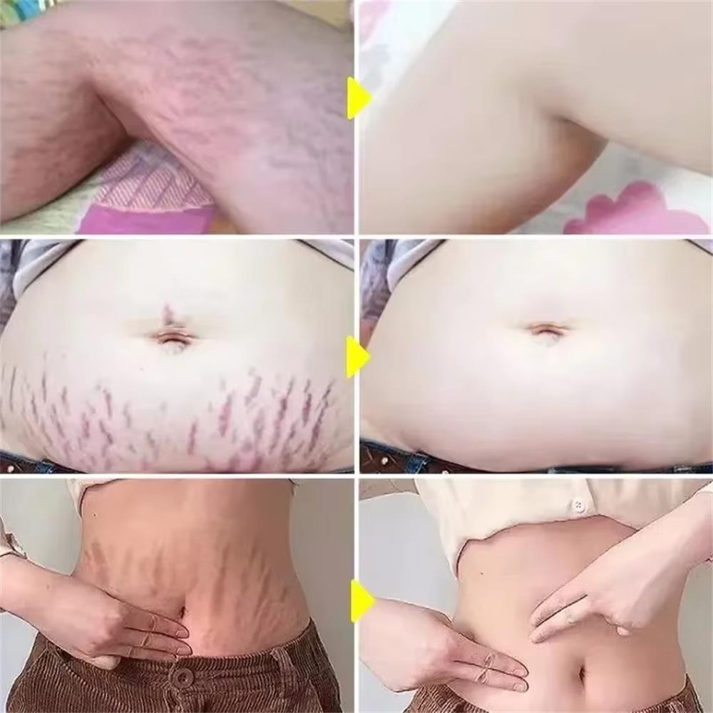 100g Stretch Marks Permanent R - огляд і ціна Teeth Whitening Pregnancy