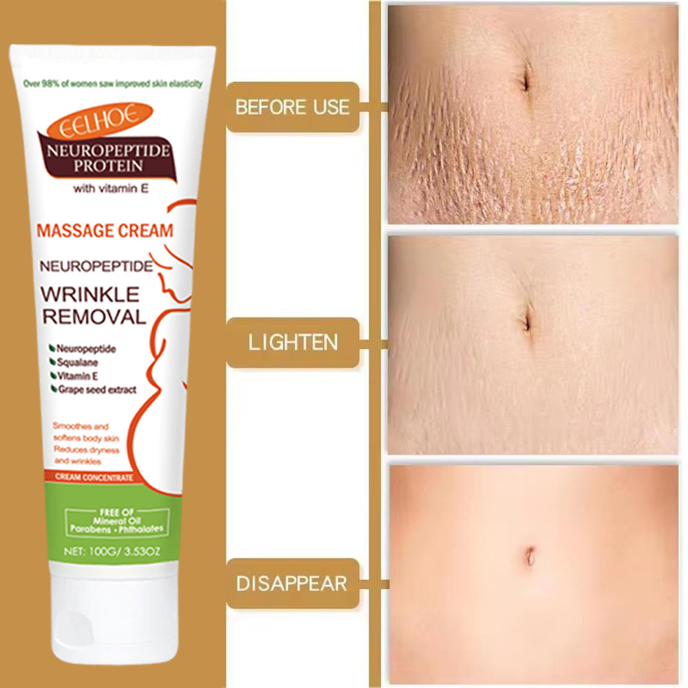 100g Stretch Marks Permanent R - огляд і ціна Teeth Whitening Pregnancy